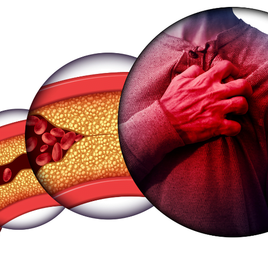 Ischemic heart disease could be very dangerous if not treated (Chaparral Pharmacy) (a photo of narrowing arteries and a man holding his chest)