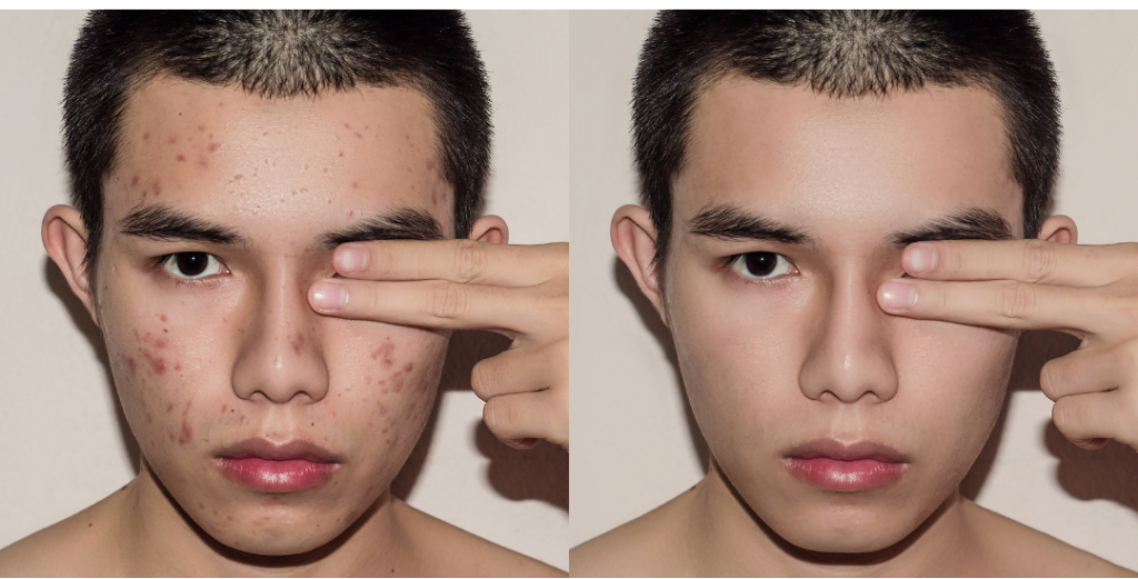 acne e1665421640736